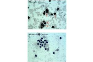 ADORA3 antibody staining of Oral Cell Carcinoma at a dilution of 5 ug/ml (Adenosine A3 Receptor Antikörper  (C-Term))