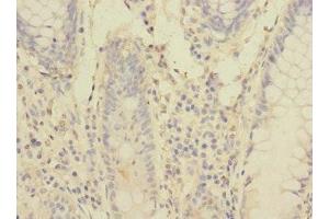 Immunohistochemistry of paraffin-embedded human colon cancer using ABIN7166553 at dilution of 1:100 (Protocadherin 1 Antikörper  (AA 60-220))
