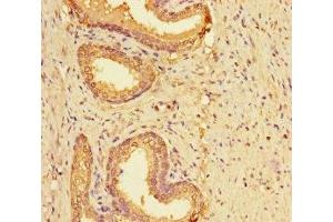 Immunohistochemistry of paraffin-embedded human prostate cancer using ABIN7158595 at dilution of 1:100 (LYPD2 Antikörper  (AA 23-103))