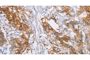 Immunohistochemistry of paraffin-embedded Human colon cancer tissue using CA9 Polyclonal Antibody at dilution 1:50 (CA9 Antikörper)