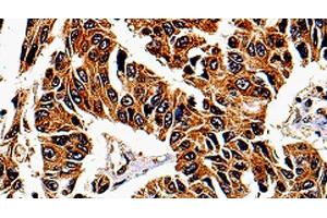 Immunohistochemistry of paraffin-embedded Human lung cancer tissue using IL13RA1 Polyclonal Antibody at dilution 1:50 (IL13 Receptor alpha 1 Antikörper)