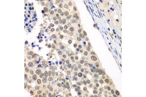 Immunohistochemistry of paraffin-embedded human lung cancer using HDAC2 antibody. (HDAC2 Antikörper  (C-Term))