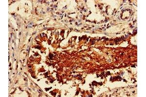 Immunohistochemistry of paraffin-embedded human lung cancer using ABIN7158291 at dilution of 1:100 (LAIR1 Antikörper  (AA 22-165))