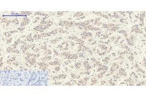 Immunohistochemistry of paraffin-embedded Human liver cancer tissue using TGFB1 Polyclonal Antibody at dilution of 1:200. (TGFB1 Antikörper)