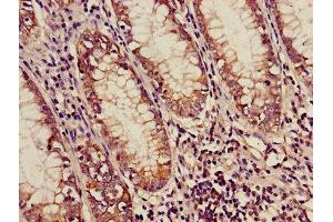 Immunohistochemistry of paraffin-embedded human colon cancer using ABIN7159169 at dilution of 1:100 (Medium-Chain Specific Acyl-CoA Dehydrogenase, Mitochondrial (AA 26-421) Antikörper)