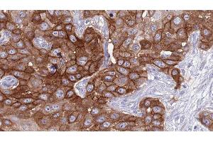 ABIN6277036 at 1/100 staining Human Head and neck cancer tissue by IHC-P.