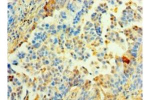 Immunohistochemistry of paraffin-embedded human lung cancer using ABIN7142344 at dilution of 1:100 (MRPL1 Antikörper  (AA 51-324))
