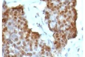 IHC testing of gastric carcinoma stained with Estrogen Receptor beta antibody (ESR2 Antikörper  (C-Term))