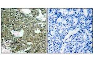 Immunohistochemical analysis of paraffin-embedded human breast carcinoma tissue using MEK1 (phospho- Ser221) antibody (E011161). (MEK1 Antikörper  (pSer221))