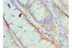 Immunohistochemistry of paraffin-embedded human colon cancer using ABIN7174029 at dilution of 1:100 (HCK Antikörper  (AA 1-220))
