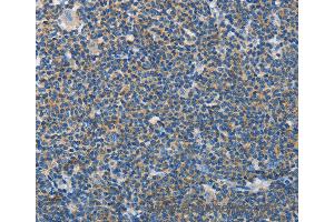 Immunohistochemistry of Human thyroid cancer using NEK5 Polyclonal Antibody at dilution of 1:60