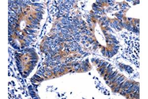 The image on the left is immunohistochemistry of paraffin-embedded Human colon cancer tissue using ABIN7129604(GIP Antibody) at dilution 1/13, on the right is treated with fusion protein. (GIP Antikörper)