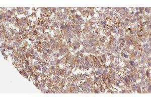 ABIN6279229 at 1/100 staining Human Melanoma tissue by IHC-P. (CALML3 Antikörper  (Internal Region))