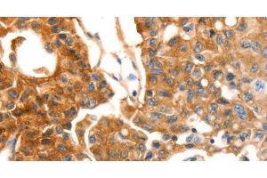 Immunohistochemistry of paraffin-embedded Human lung cancer using MVP Polyclonal Antibody at dilution of 1:30