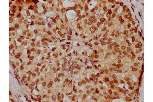 IHC image of ABIN7164247 diluted at 1:200 and staining in paraffin-embedded human breast cancer performed on a Leica BondTM system. (Lamin A/C Antikörper  (AA 385-572))