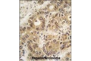 Formalin-fixed and paraffin-embedded human hepatocarcinoma tissue reacted with ZIC3 antibody (N-term) (ABIN389243 and ABIN2839388) , which was peroxidase-conjugated to the secondary antibody, followed by DAB staining. (ZIC3 Antikörper  (N-Term))