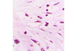 Immunohistochemical analysis of SUPT3H staining in human lung cancer formalin fixed paraffin embedded tissue section. (SUPT3H/SPT3 Antikörper  (Center))