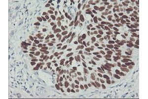 Immunohistochemical staining of paraffin-embedded Carcinoma of Human lung tissue using anti-TP53 mouse monoclonal antibody. (p53 Antikörper)