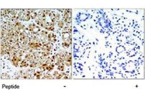 Immunohistochemical analysis of paraffin-embedded human breast carcinoma tissue using HSP90AB1 polyclonal antibody  . (HSP90AB1 Antikörper)