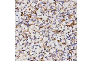 Immunohistochemistry of paraffin-embedded human kidney cancer tissue using CA4 antibody at dilution of 1:200 (x400 lens)