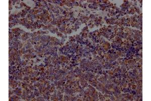 IHC image of ABIN7127319 diluted at 1:100 and staining in paraffin-embedded human lung cancer performed on a Leica BondTM system. (Rekombinanter ACO2 Antikörper)