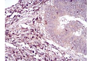 Immunohistochemical analysis of paraffin-embedded rectum cancer tissues using CD6 mouse mAb with DAB staining. (CD6 Antikörper  (AA 18-199))