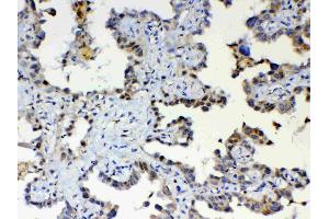 IHC analysis of ETV6/Tel using anti-ETV6/Tel antibody .