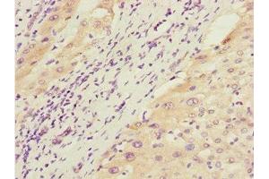 Immunohistochemistry of paraffin-embedded human liver cancer using ABIN7172660 at dilution of 1:100