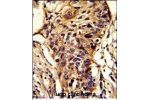 Formalin-fixed and paraffin-embedded human lung carcinoma reacted with BCKDHA Antibody (C-term), which was peroxidase-conjugated to the secondary antibody, followed by DAB staining. (BCKDHA Antikörper  (C-Term))