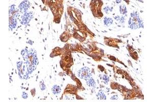 Formalin-fixed, paraffin-embedded human breast carcinoma stained with EMA antibody (MUC1/845). (MUC1 Antikörper)