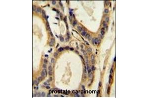 CCL4 Antibody (Center) (ABIN654131 and ABIN2850474) immunohistochemistry analysis in formalin fixed and paraffin embedded human prostate carcinoma followed by peroxidase conjugation of the secondary antibody and DAB staining. (CCL4 Antikörper  (AA 22-48))