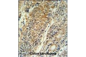 PYCR1 Antibody (C-term) (ABIN653849 and ABIN2843112) IHC analysis in formalin fixed and paraffin embedded colon carcinoma followed by peroxidase conjugation of the secondary antibody and DAB staining.