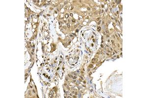 Immunohistochemistry of paraffin-embedded human esophageal cancer using ERK1/2 Rabbit mAb (ABIN7268620) at dilution of 1:100 (40x lens). (ERK1 Antikörper)