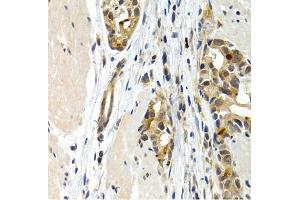 Immunohistochemistry of paraffin-embedded human stomach cancer using IL9 antibody (ABIN3015677, ABIN3015678, ABIN1680463 and ABIN6219030) at dilution of 1:200 (40x lens). (IL-9 Antikörper  (AA 19-144))