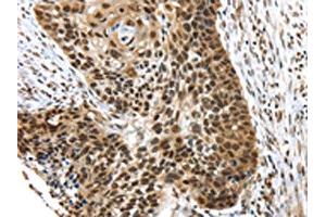 The image on the left is immunohistochemistry of paraffin-embedded Human esophagus cancer tissue using ABIN7192767(TEX37 Antibody) at dilution 1/40, on the right is treated with synthetic peptide. (TEX37 Antikörper)