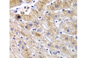 Immunohistochemistry of paraffin-embedded Human liver damage using DPP3 Polyclonal Antibody at dilution of 1:100 (40x lens). (DPP3 Antikörper)