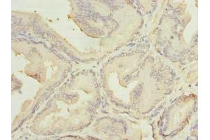 Immunohistochemistry of paraffin-embedded human prostate cancer using ABIN7159116 at dilution of 1:100 (MED18 Antikörper  (AA 35-208))