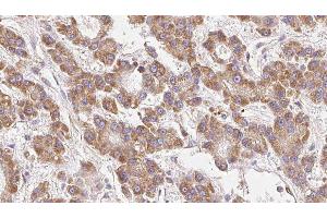 ABIN6279174 at 1/100 staining Human liver cancer tissue by IHC-P. (KCNJ10 Antikörper  (Internal Region))