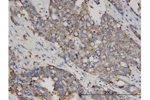 Immunoperoxidase of monoclonal antibody to LGALS4 on formalin-fixed paraffin-embedded human ovarian cancer. (GAL4 Antikörper  (AA 51-150))