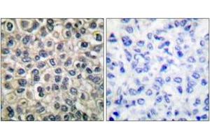 Immunohistochemistry analysis of paraffin-embedded human breast carcinoma tissue, using Catenin-gamma Antibody. (JUP Antikörper  (AA 696-745))