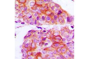 Immunohistochemical analysis of EGFR staining in human breast cancer formalin fixed paraffin embedded tissue section.