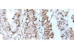 Immunohistochemistry of paraffin-embedded Human liver cancer tissue using ZNHIT3 Polyclonal Antibody at dilution of 1:80(x200) (ZNHIT3 Antikörper)