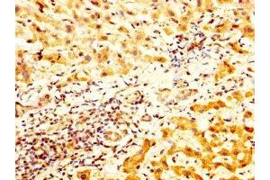 IHC image of ABIN7171412 diluted at 1:800 and staining in paraffin-embedded human liver cancer performed on a Leica BondTM system.