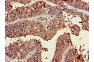 Immunohistochemistry of paraffin-embedded human endometrial cancer using ABIN7173463 at dilution of 1:100 (TRIM54 Antikörper  (AA 60-358))