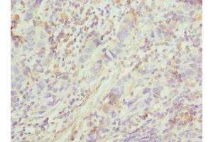 Immunohistochemistry of paraffin-embedded human bladder cancer using ABIN7153264 at dilution of 1:100 (FGD5 Antikörper  (AA 1203-1462))