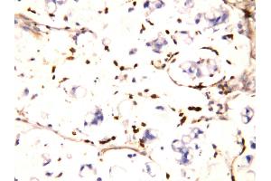 Anti-IFITM1 antibody, IHC(P) IHC(P): Human Intestinal Cancer Tissue (IFITM1 Antikörper  (N-Term))