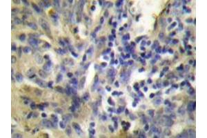 Immunohistochemistry analyzes of Cystatin A antibody in paraffin-embedded human lung carcinoma tissue. (CSTA Antikörper)