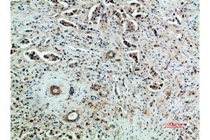Immunohistochemical analysis of paraffin-embedded human-breast-cancer, antibody was diluted at 1:200. (VEGFR2/CD309 Antikörper  (AA 1268-1341))