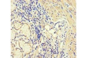 Immunohistochemistry of paraffin-embedded human gastric cancer using ABIN7148597 at dilution of 1:100 (CORO1B Antikörper  (AA 252-453))
