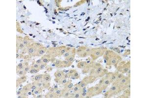 Immunohistochemistry of paraffin-embedded Human liver damage using LETMD1 Polyclonal Antibody at dilution of 1:100 (40x lens). (LETMD1 Antikörper)